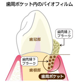 歯周ポケット内バイオフィルム